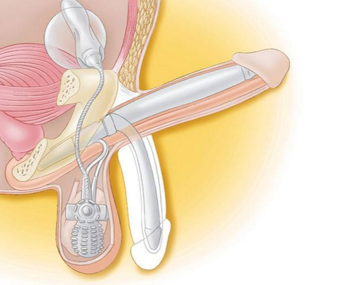  AMS 700™ Schwellkörperimplantat