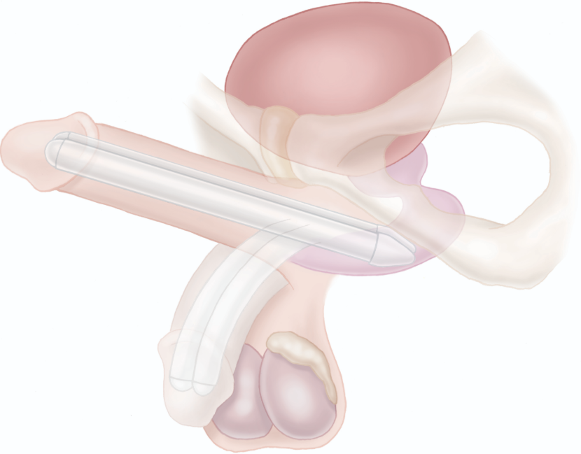 TACTRA™ BIEGSAMES SCHWELLKÖRPERIMPLANTAT