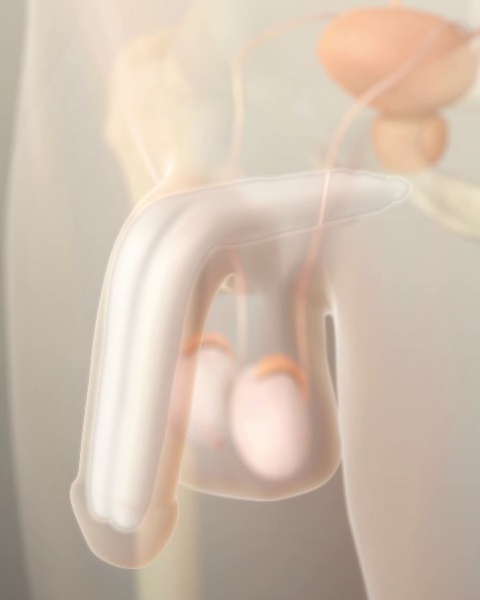 Ams ambicor penisprothese video anmation.