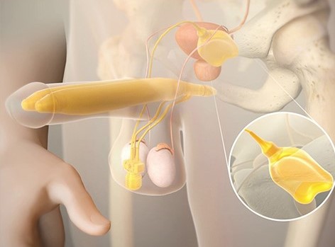 Ams700 Penisimplantat Videoanimation.