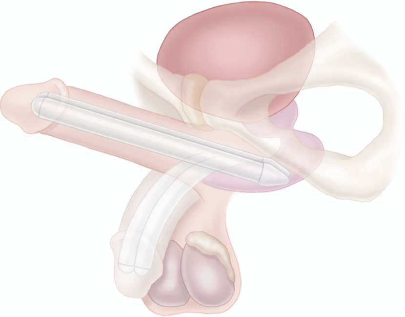 Tactra penile prothesis illustration.