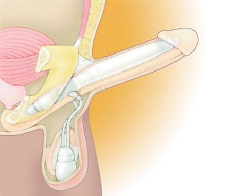 AMS Ambicor™ Schwellkörperimplantat